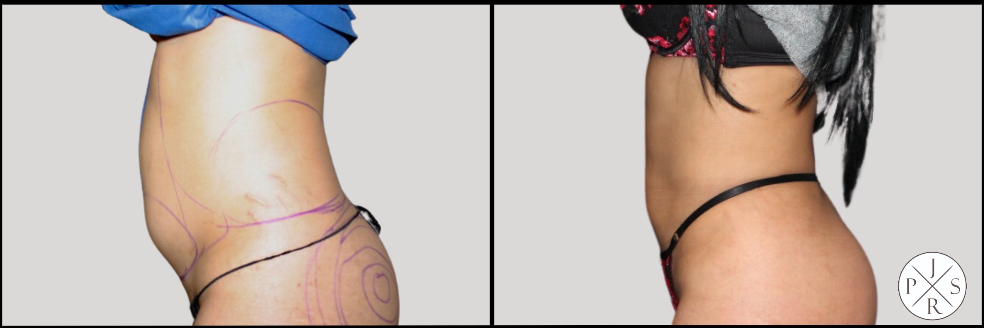 Liposuction Before & After Image